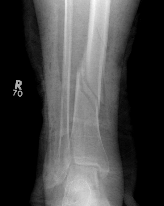 Distal Tibia Intra-articular